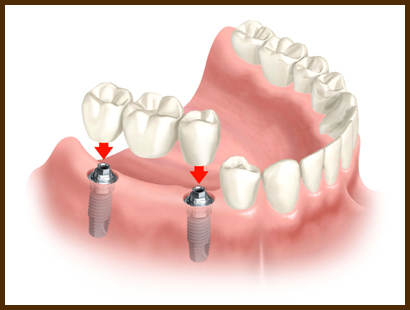 tooth-implants