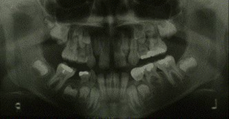 نتیجه از دست رفتن زودهنگام دندان شیری